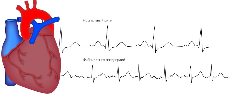 Мерцательная аритмия сердца картинки